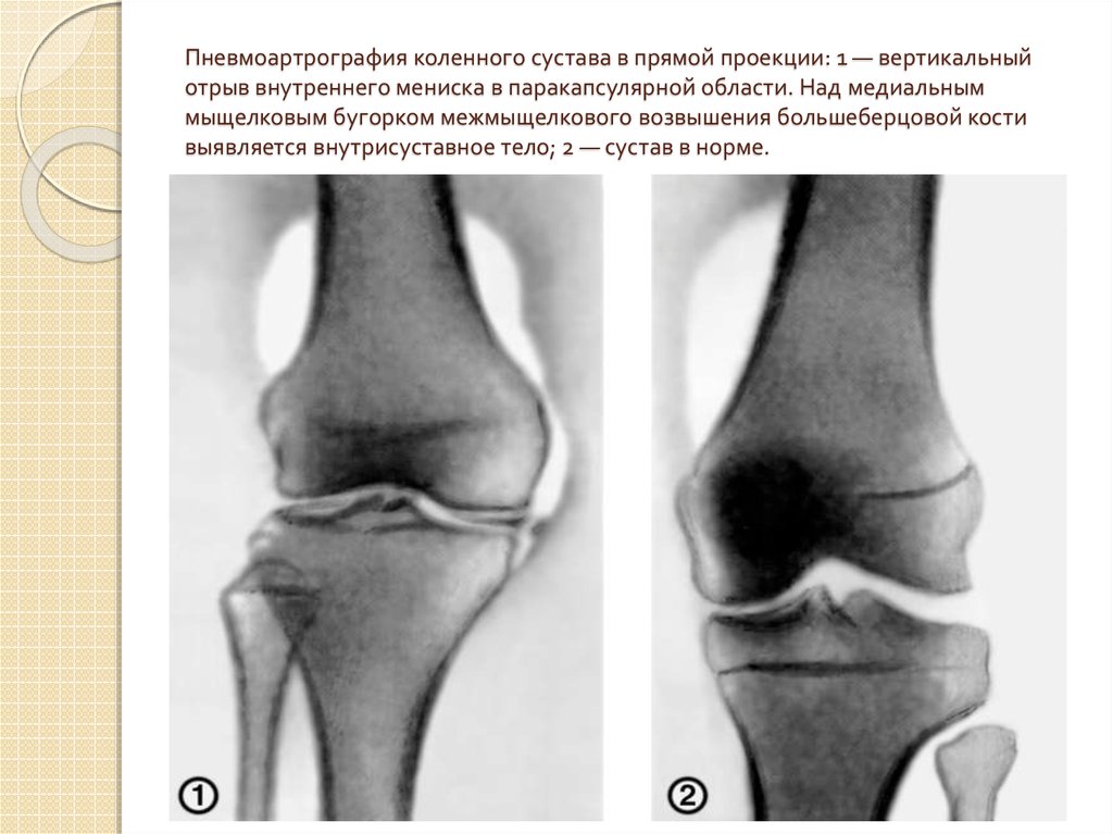 Рентген коленного сустава в двух проекциях фото в норме