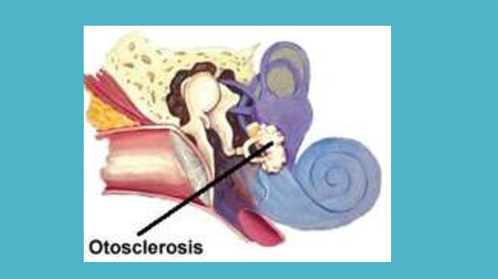 Отосклероз по утвержденным клиническим рекомендациям. Отосклероз стапедопластика. Отосклероз клинические рекомендации. Смешанная тугоухость отосклероз.