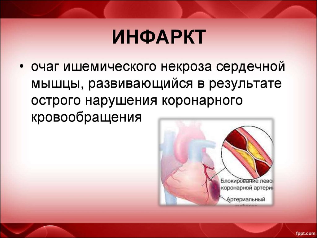 Что такое инфаркт. При инфаркте миокарда в сердечной мышце развивается. Инфаркт это простыми словами. В результате чего развивается инфаркт.