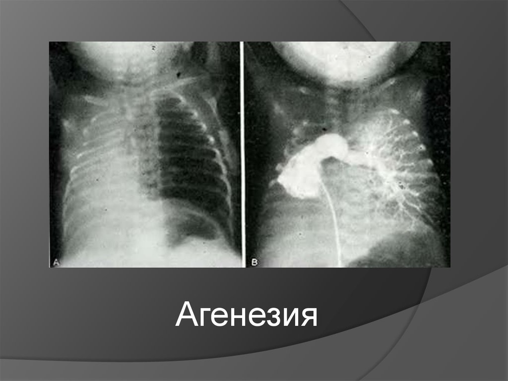 Агенезия венозного. Агенезия легкого рентген. Агенезия (аплазия) бронхов. Гипоплазия и аплазия легкого. Врожденные пороки развития дыхательной системы.