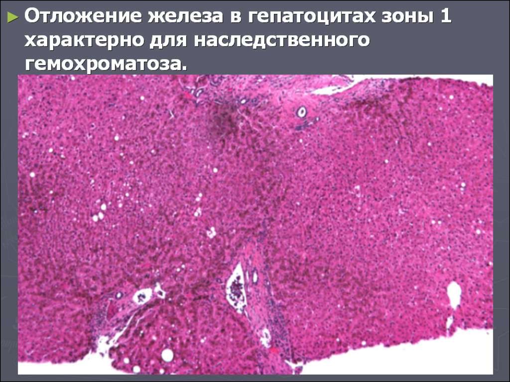 Гемохроматоз симптомы. Гемохроматоз поджелудочной железы. Отложение железа в печени. Печень при гемохроматозе микропрепарат.