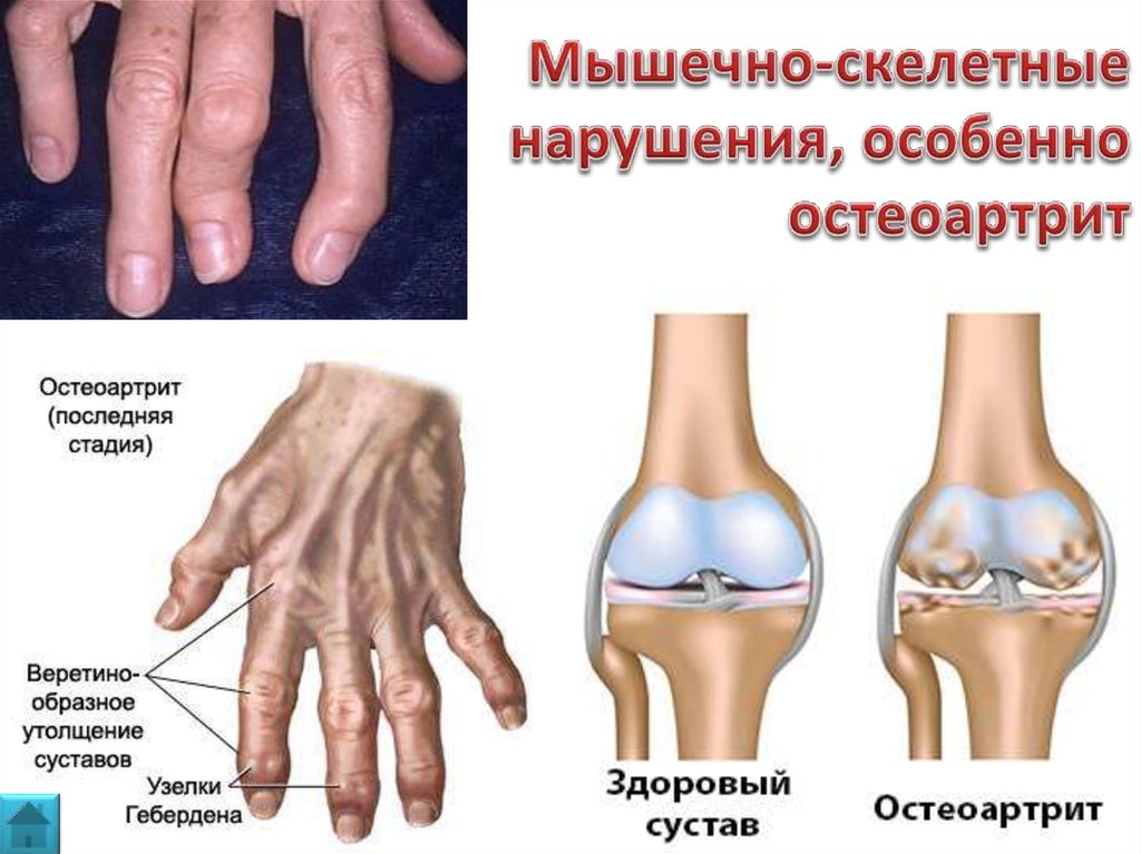 Ревматоидный артрит мышцы. Узуры ревматоидного артрита. Ревматоидный артрит и остеоартрит. Псориазный ревматоидный артрит. Ревматоидный артрит ревматоидные узелки.
