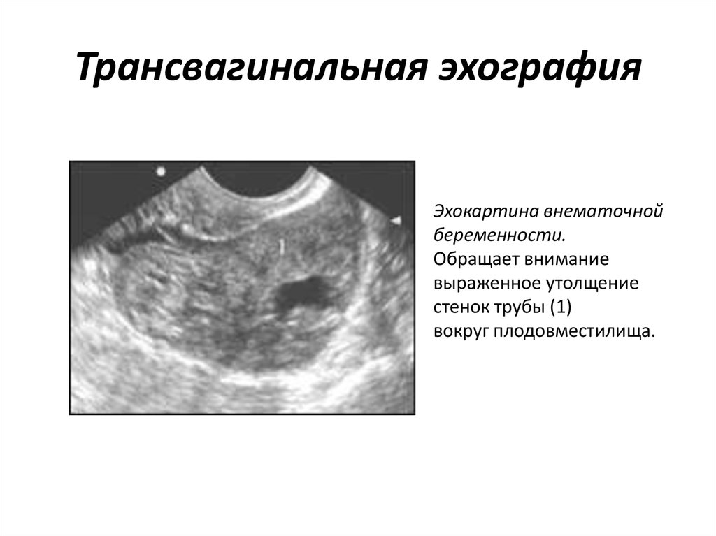 Внематочная беременность симптомы на ранних сроках фото