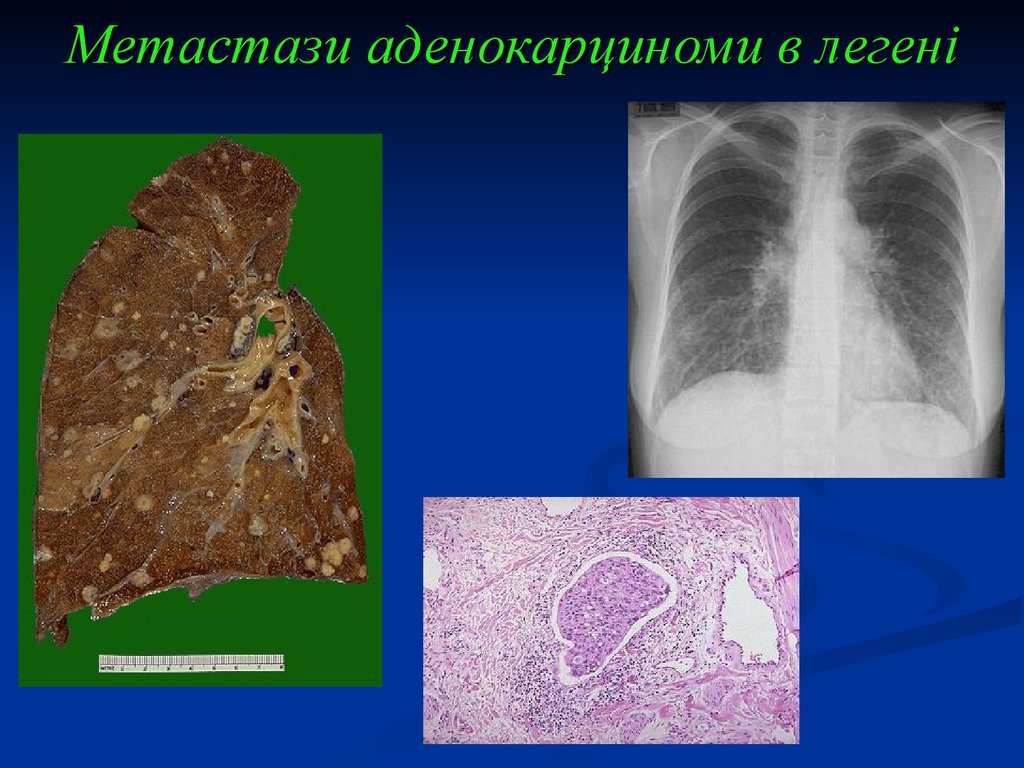 Метастазы что это. Метастатический плеврит аденокарцинома. Ацинарная аденокарцинома легкого. Метастазирование в легкие.