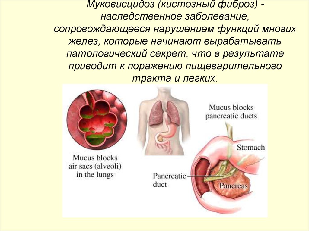 Муковисцидоз что это за болезнь