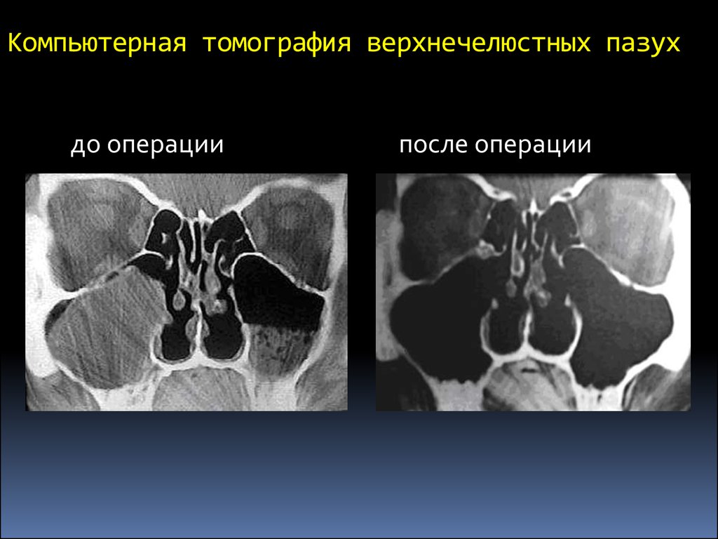 Кт пазух. Остеома гайморовой пазухи на кт. Ороантральный свищ верхнечелюстной пазухи. Фистула верхнечелюстной пазухи кт. Кт остеомиелит гайморовой пазухи.