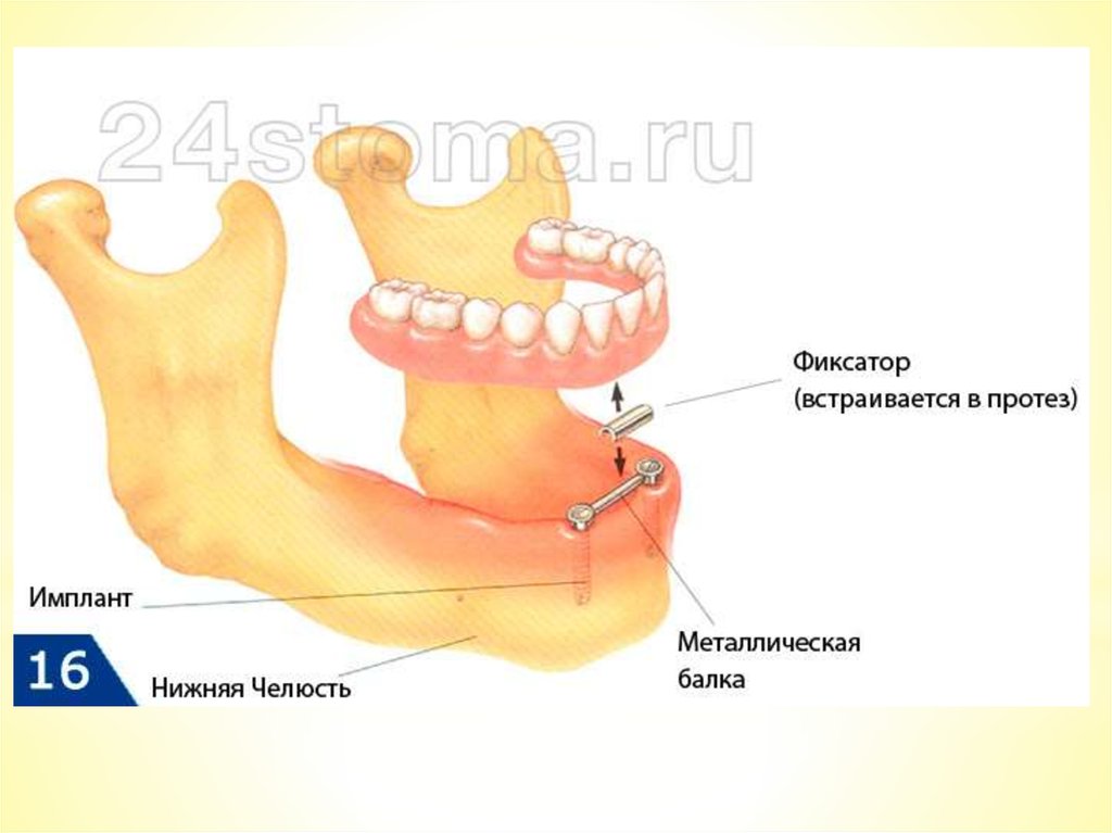 Условный протез. Балочная фиксация съемных протезов. Балочная система фиксации. Штанговая фиксация протезов. Балочная (штанговая) фиксация.