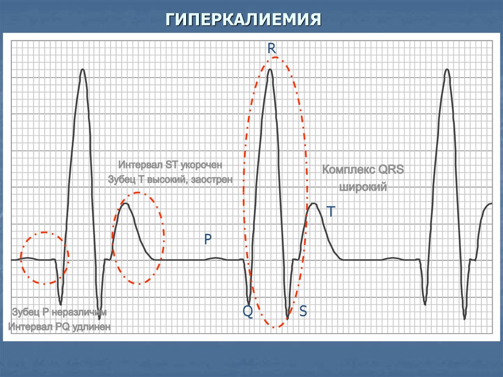 Зубец т. Признаки гиперкалиемии на ЭКГ. ЭКГ при гиперкалиемии. ЭКГ зубец т гиперкалиемия. Зубец т на ЭКГ при гиперкалиемии.