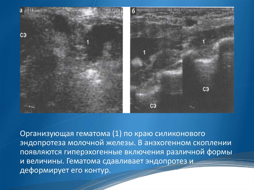 Ушиб молочной железы. Гематома молочной железы. Гематома молочной железы на УЗИ протокол. Гематома в молочной железе на УЗИ. Гиперэхогенные образования в молочной железе.