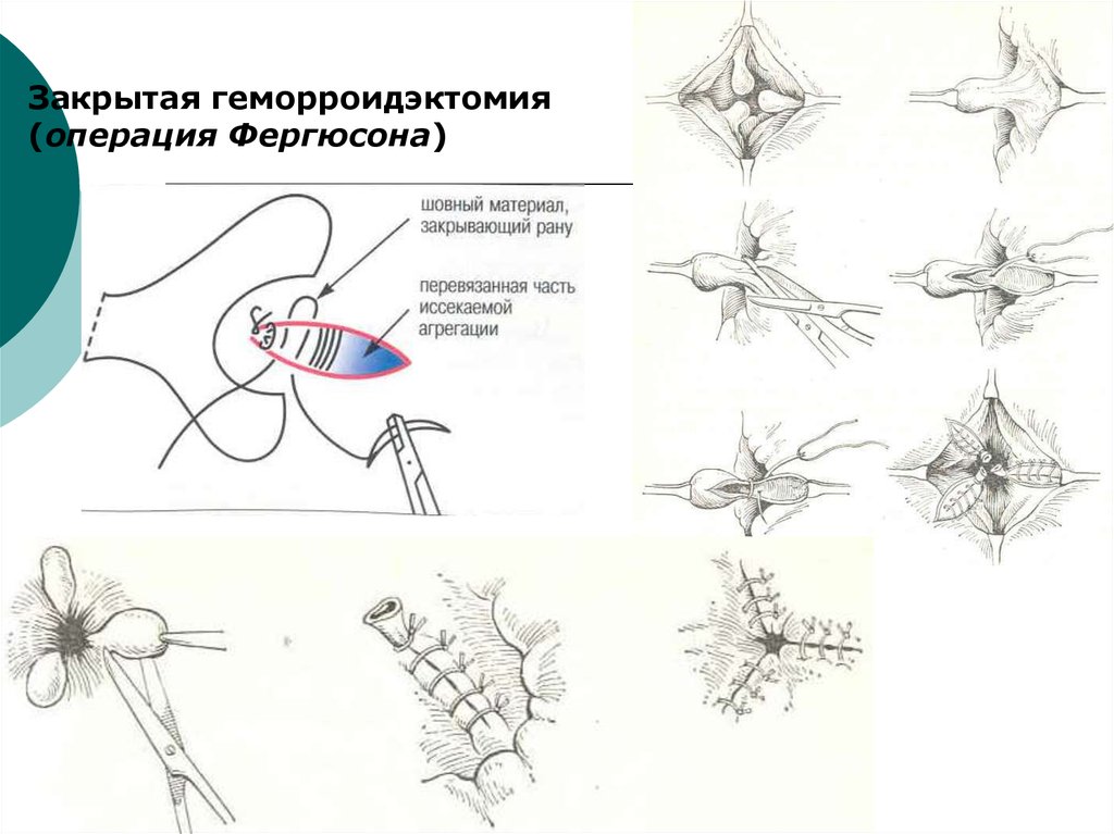 Удаление узла. Операция Миллигана-Моргана, Фергюсона. Закрытая геморроидэктомия по Фергюсону. Геморроидэктомия схема операции.