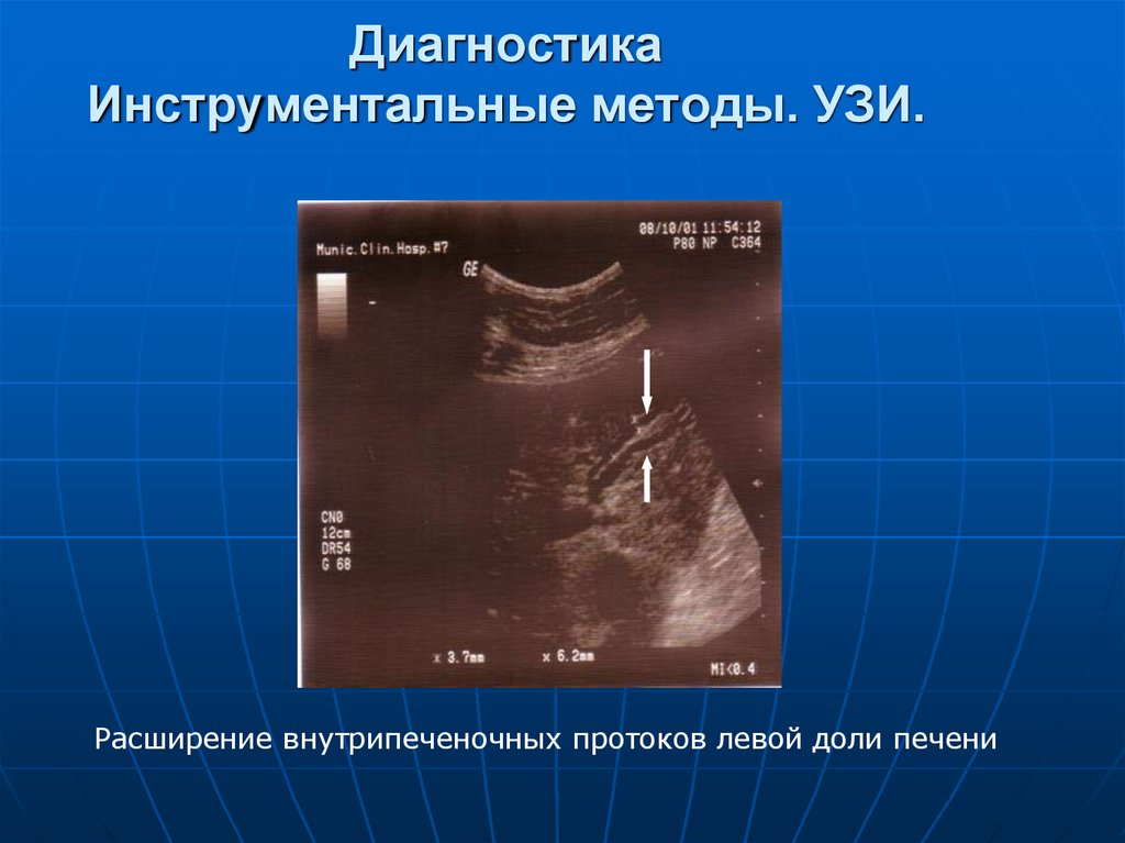 Расширение протоков печени. Расширение внутрипеченочных желчных протоков УЗИ. А метод УЗИ. Расширение желчных протоков на УЗИ. Расширение внутрипеченочных протоков на УЗИ.