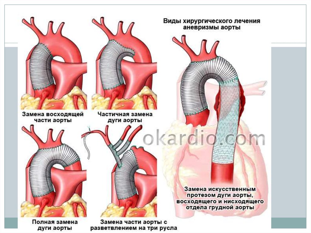 Как лечится аорта