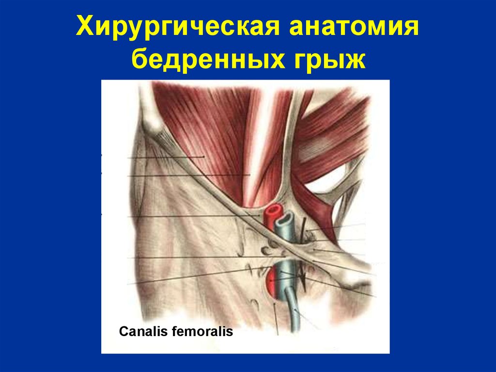 Ущемленная бедренная грыжа. Бедренной и запирательной грыжи. Хирургическая анатомия бедренных грыж. Хирургическая анатомия паховой грыжи. Бедренный канал, Canalis femoralis.
