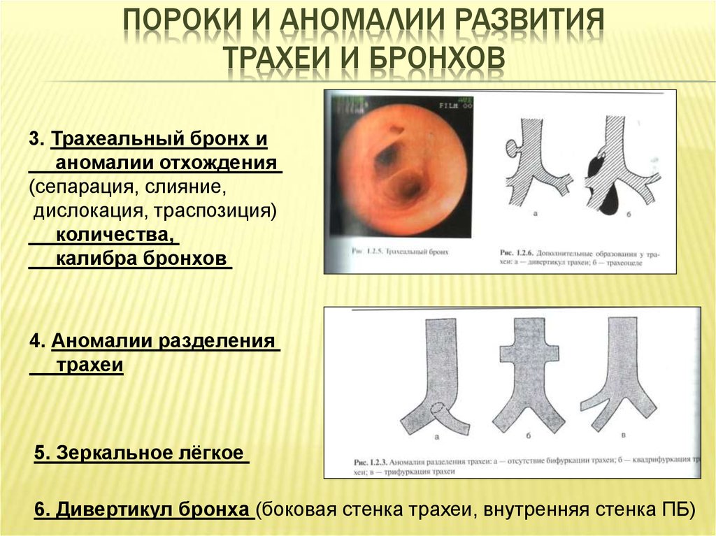 Аномалии развития. Врожденная аномалия бронхов кт. Аномалии развития бронхов на кт. Пороки развития бронхиального дерева. Врожденная патология трахеи.