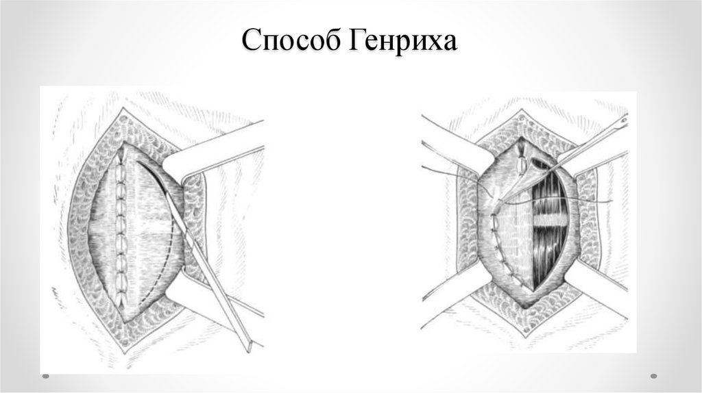 Герниопластика пупочной грыжи