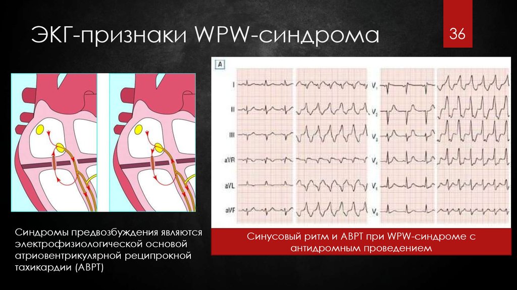 Синдром впв презентация