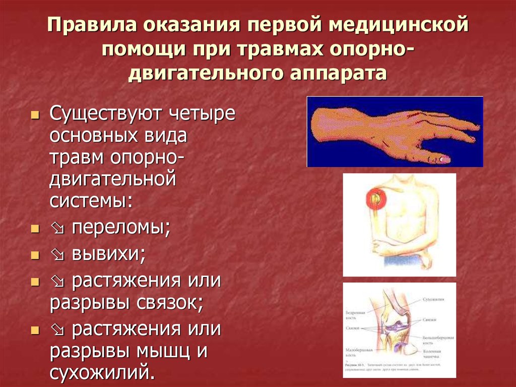 Переломы и вывихи презентация