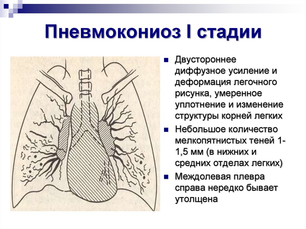 Признаки усиления бронхо сосудистого рисунка