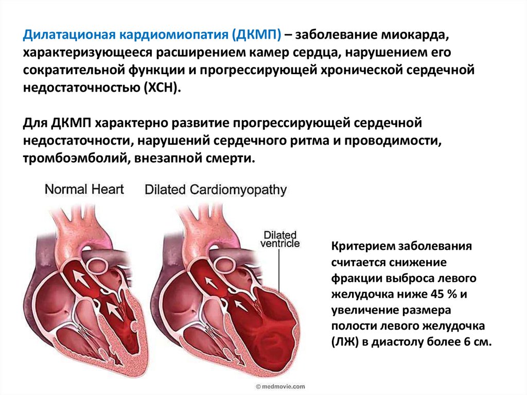 Кардиомиопатия сердца что это. Кардиомиопатии патанатомия. Нарушение проводимости миокарда. Кардиомиопатия 2 степени. Кардиомиопатия сердца смерть.