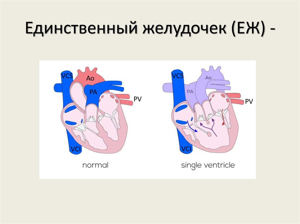 Операция фонтена на сердце схема