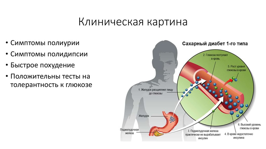 Симптомы клиническая картина. Клинические проявления сахарного диабета 1 типа. Клиническая картина диабета 1 типа. Клиническая картина диабета 2 типа. Клинические симптомы сахарного диабета 2 типа.