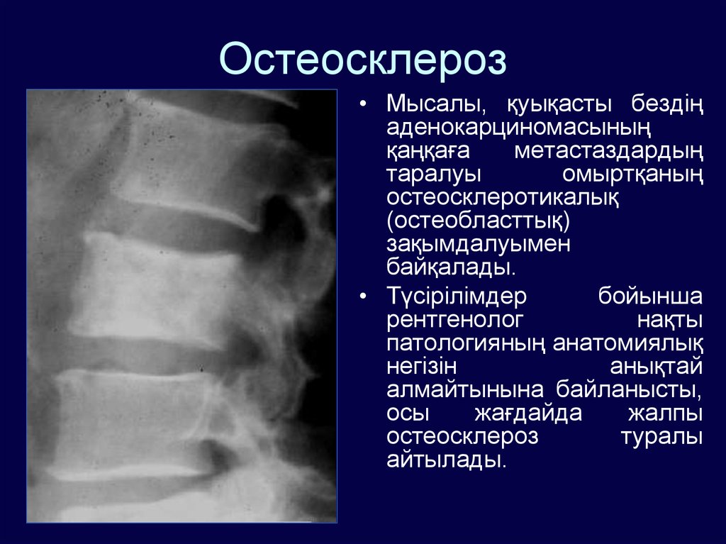 Остеосклероз тазобедренного