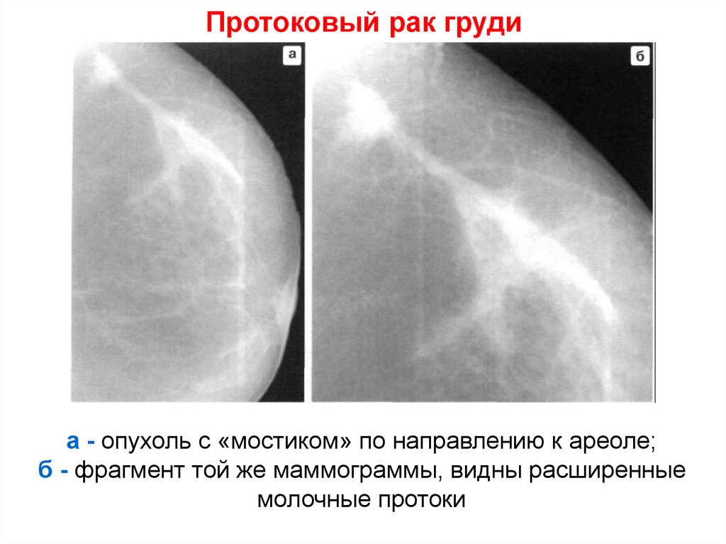 Расширение протоков. Расширение протоков молочной железы на рентгене. Опухоль протоковая молочной железы. Карцинома протока молочной железы. Опухоль молочного железа.