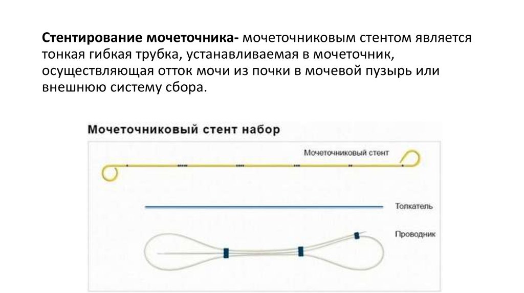 Удаление стенда из мочеточника