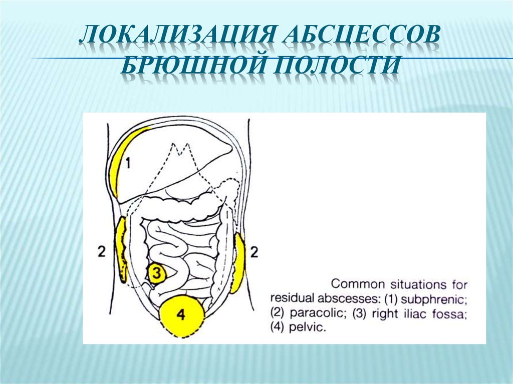 Абсцесс брюшной полости презентация