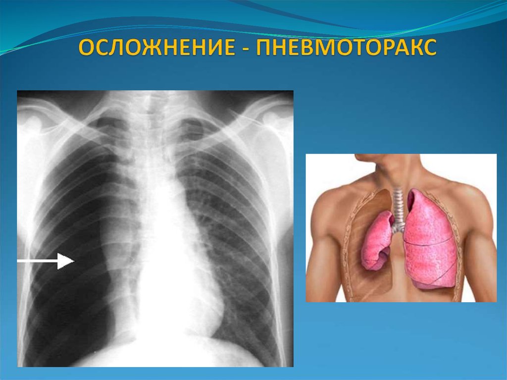 Спонтанный пневмоторакс картинки