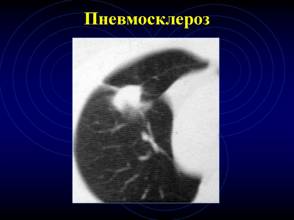 Пневмосклероз это простыми словами. Пневмосклероз рентген. Диффузный пневмосклероз рентген. Пневмосклероз легких рентген.