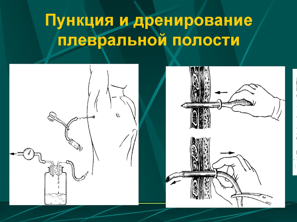 Дренирования полостей. Дренаж для плевральной пункции. Дренирование плевральной пункции. Техника дренирования плевральной пункции. Троакар при плевральной пункции.