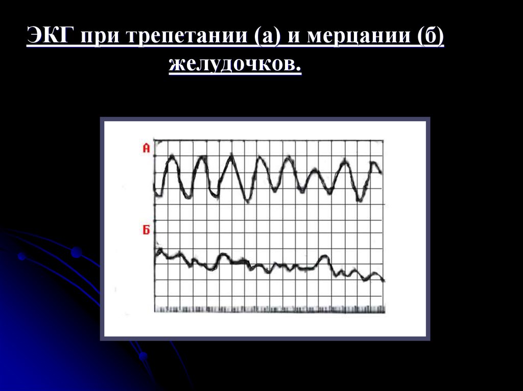 Мерцание на экг. Трепетание и мерцание желудочков на ЭКГ. Мерцание фибрилляция желудочков ЭКГ. Мерцание желудочков на ЭКГ. ЭКГ при трепетании и мерцании желудочков.