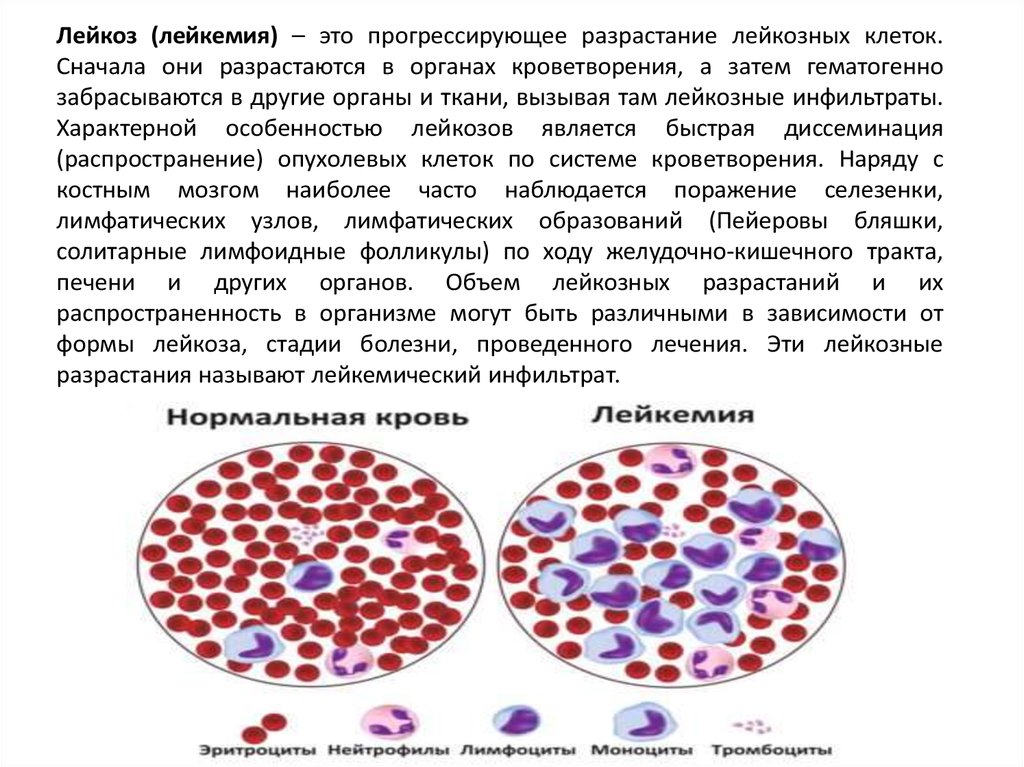 Картина крови при лейкозе