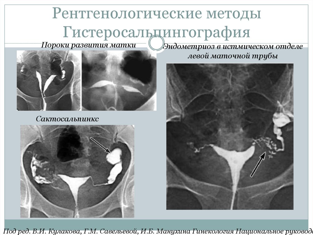 Гистеросальпингография эндометриоз