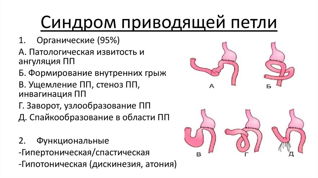 Демпинг синдром патофизиология презентация