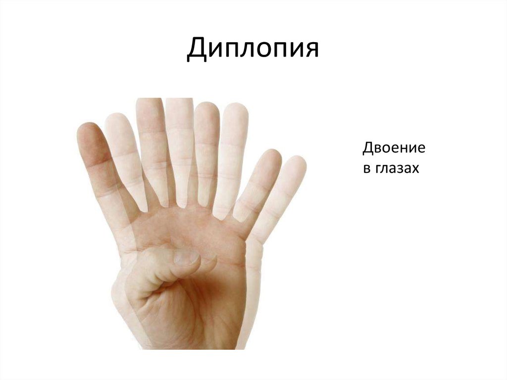 Двоение в глазах причины. Двоение в глазах. Двоение изображения. Диплопия. Двоение предметов.