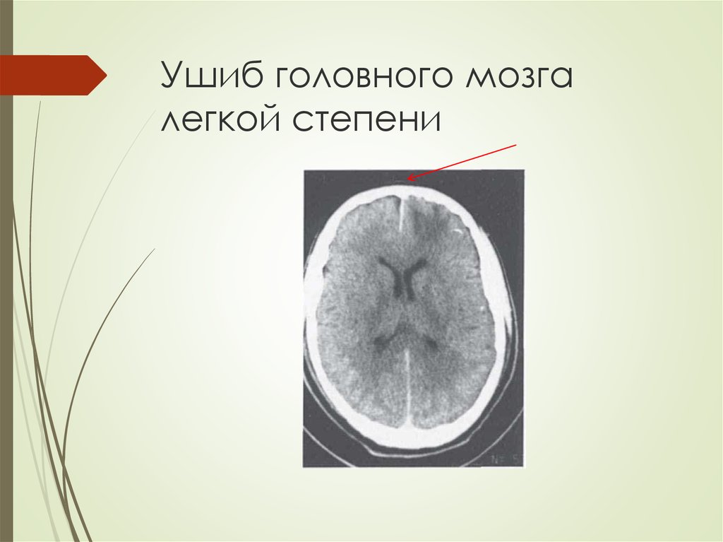 Мозг легких. Ушиб головного мозга легкой степени. Легкий ушиб головного мозга. Ушиб головного мозга степени. Ушиб головного мозга первой степени.