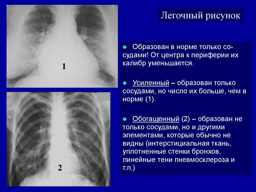 Диффузное усиление легочного рисунка что это такое на рентгене