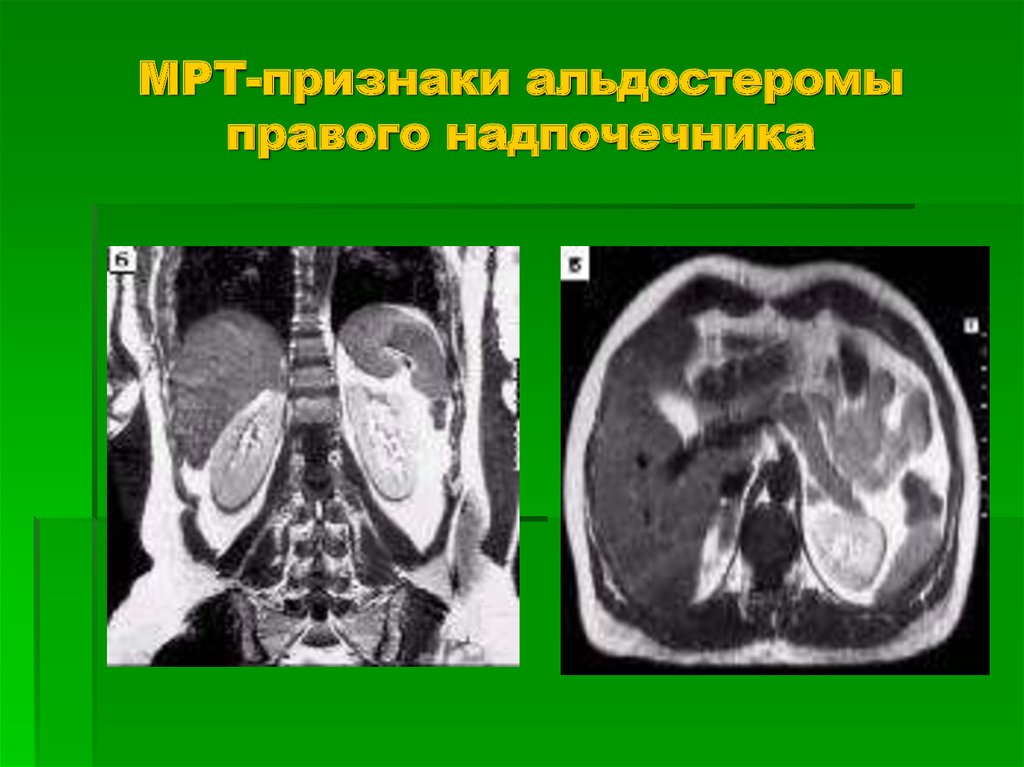 Hu надпочечника