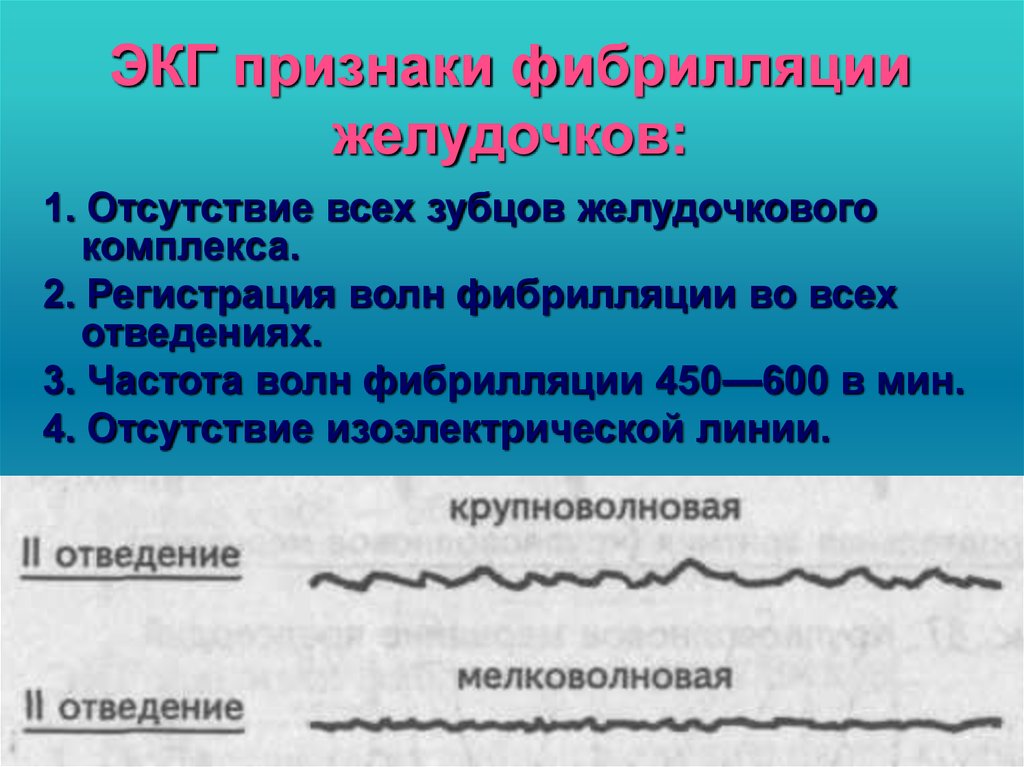 Адреналин фибрилляция желудочков