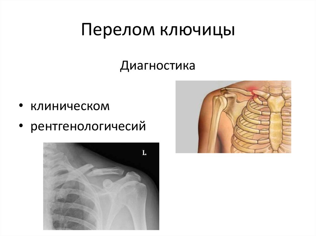 Перелом ключицы. Дистальный перелом ключицы. Перелом ключицы диагноз.