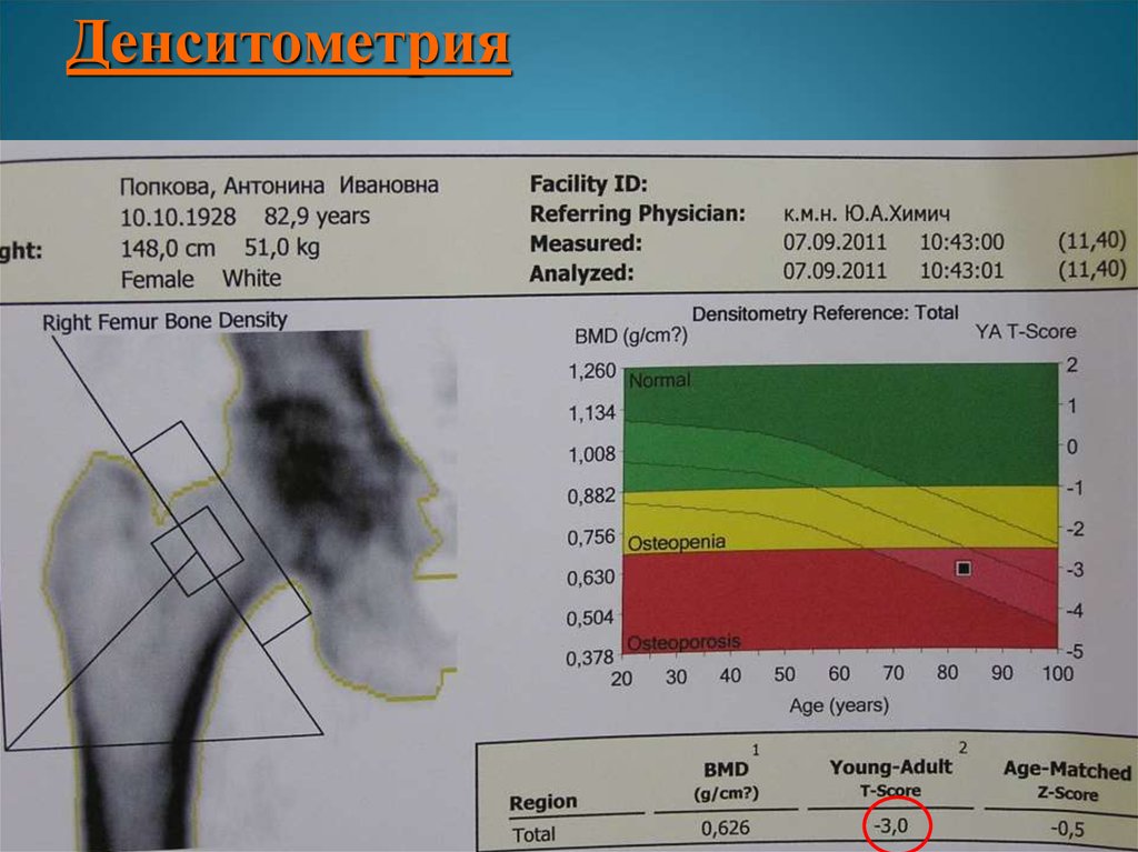 Денситометрия показатели. Денситометрия костей остеопороз. Остеопороз денситометрия заключение. Денситометрия BMD норма. Денситометрия тазобедренного сустава.