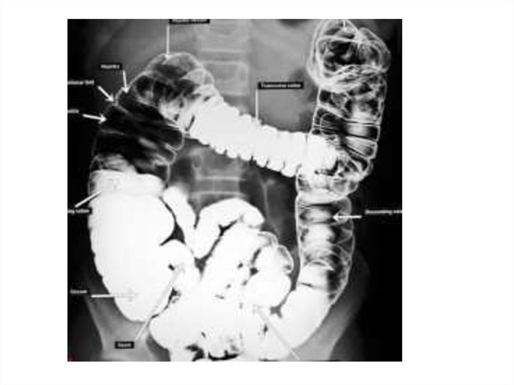 Ирригография кишечника. Кишечная непроходимость ирригография. Ирригоскопия рентген анатомия. Непроходимость Толстого кишечника рентген. Ирригоскопия Толстого кишечника рентген заключение.
