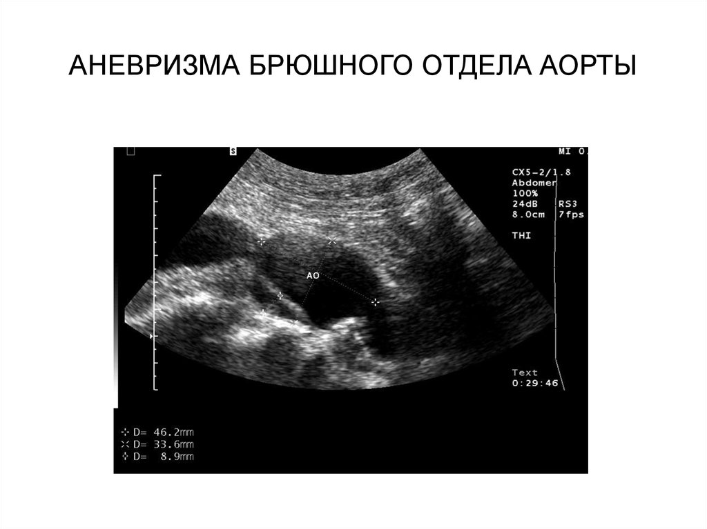 Узи брюшной аорты. Аневризма брюшного отдела аорты на УЗИ. Расслаивающая аневризма аорты ЭХОКГ. Расслаивающаяся аневризма брюшной аорты на УЗИ. Расслаивающая аневризма брюшного отдела аорты.