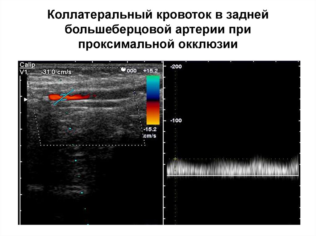 Окклюзия кровотока. Магистральный Тип кровотока УЗИ. Магистральных Тип кровотока в артерия ног. Магистральный измененный кровоток на УЗИ. Коллатеральный Тип кровотока на УЗИ.