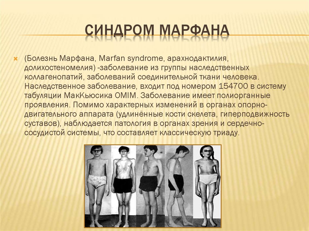 Коллагенопатия. Наследственные болезни синдром Марфана. Синдром Марфана заболевания соединительной ткани. Гиперподвижность суставов синдром Марфана. Синдром Марфана Триада.