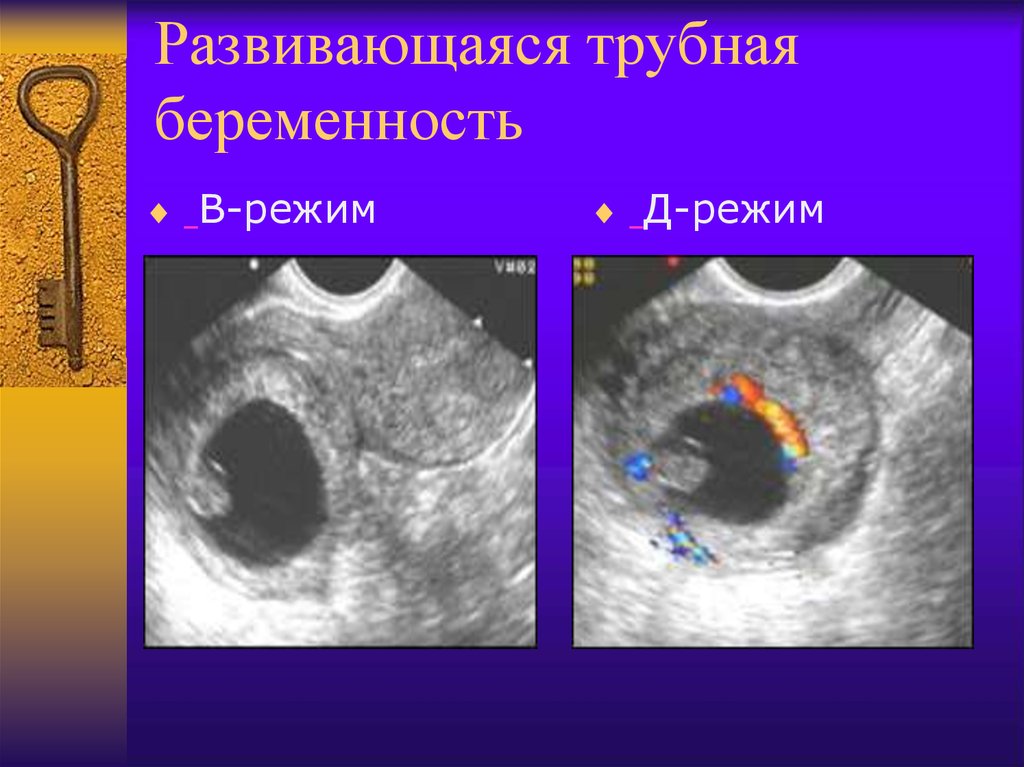 Развивающаяся внематочная беременность. Внематочная Трубная беременность УЗИ. Внематочная Трубная беременность. Ультразвуковая диагностика внематочной беременности. Внематочная беременность на УЗИ.