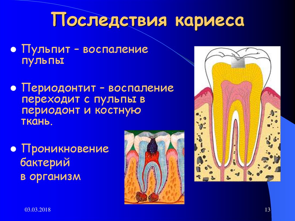 Зубов причины. Кариес зубов периодонтит болезни. Симптомы пульпит и периодонтит. Презентация «кариес, пульпит, периодонтит».