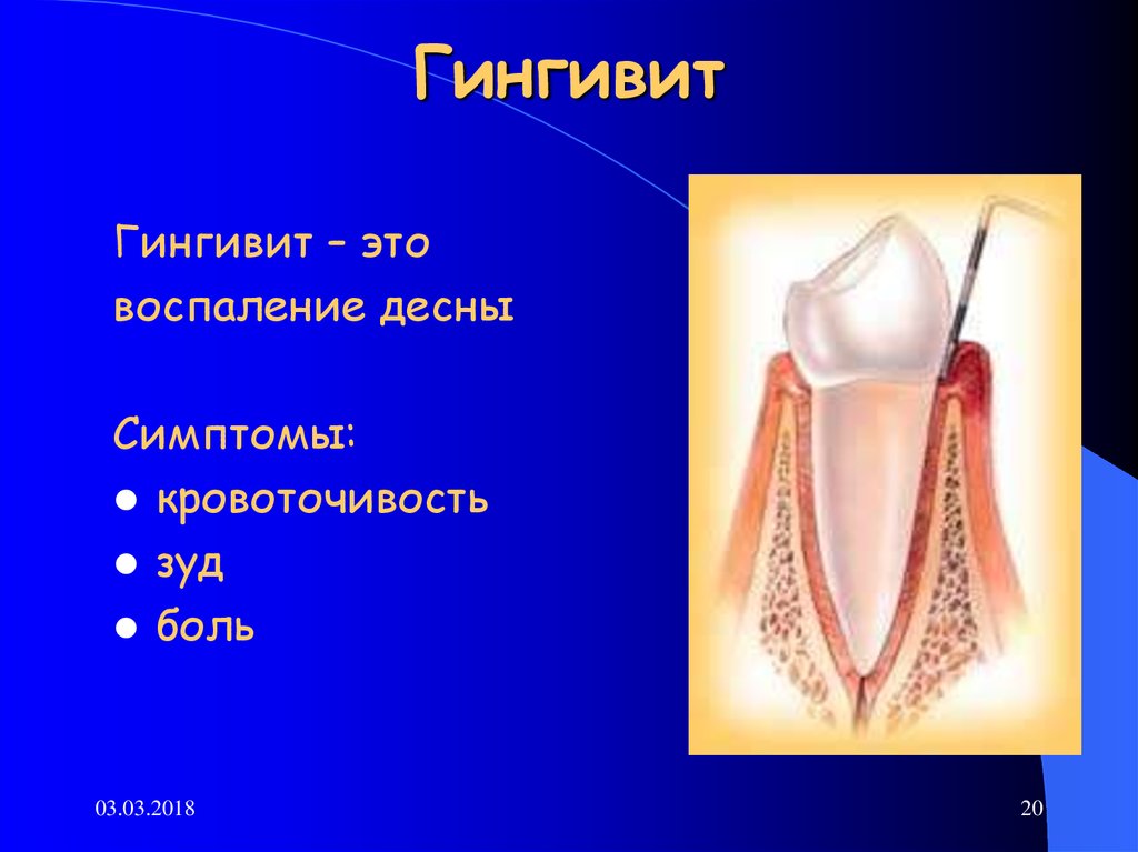 Лечение гингивита